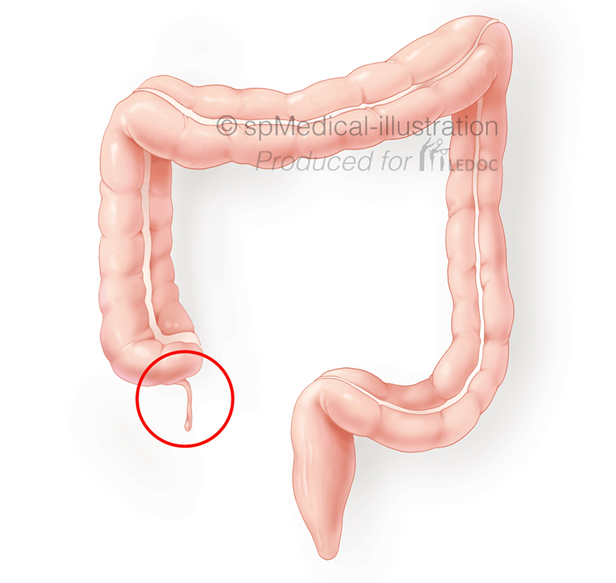 Appendicitis