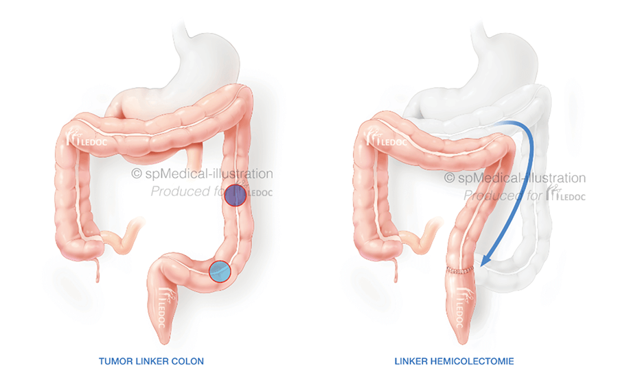 Combi links tumor colon 2