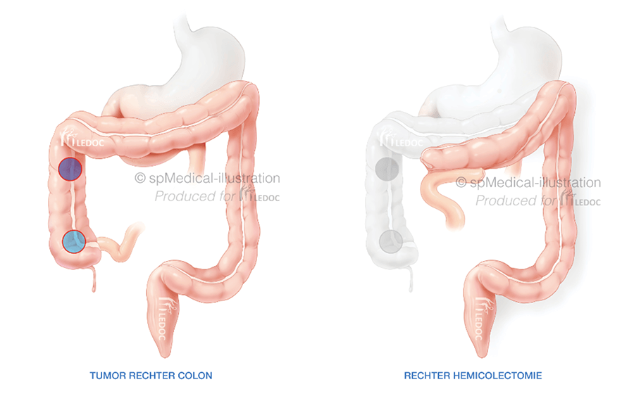 Combi rechts tumor colon