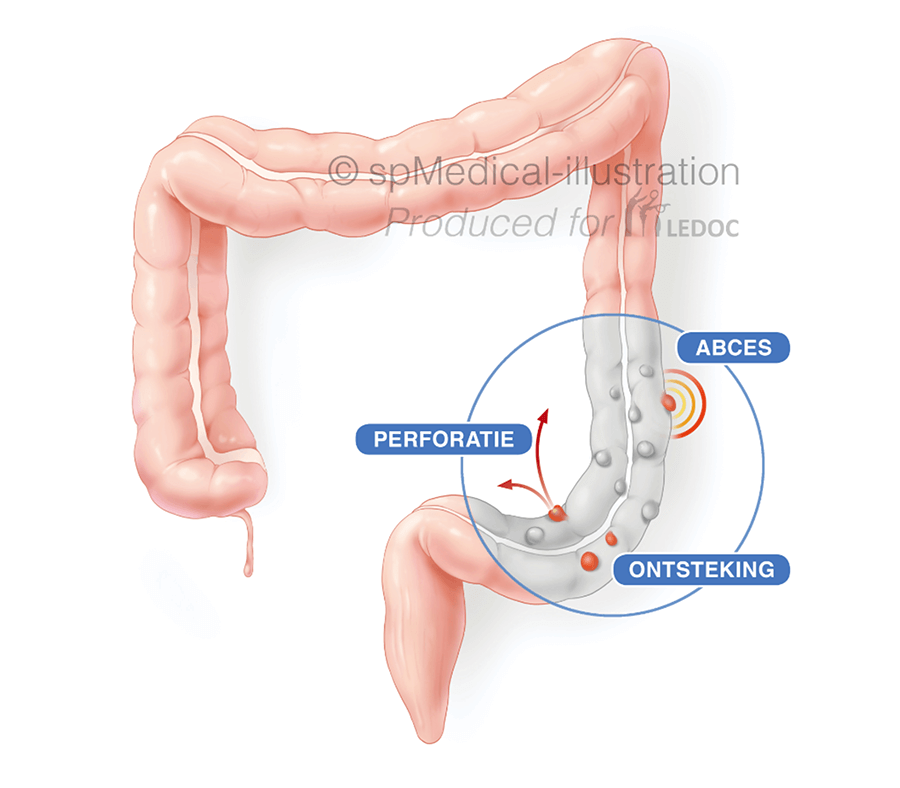 Diverticulitis