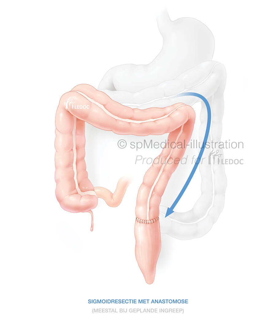 Combi links tumor colon
