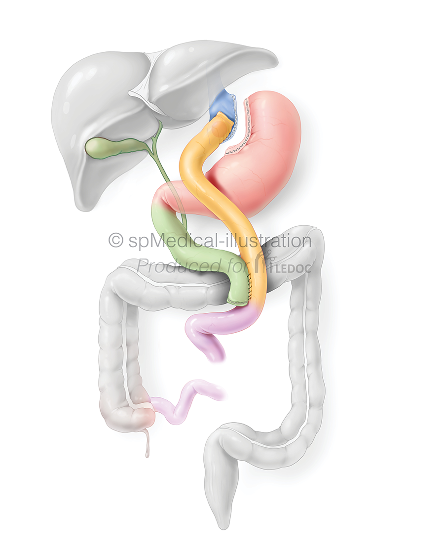 Gastric bypass
