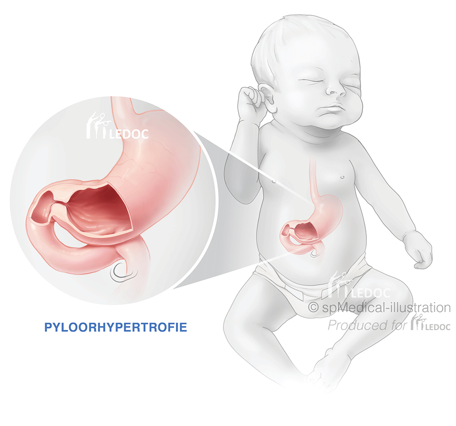 Pyloorhypertrofie