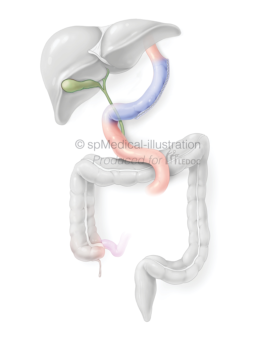 Sleeve gastrectomie