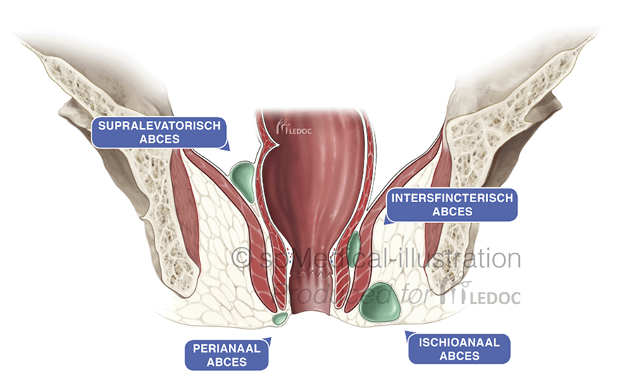 Perianaal abces