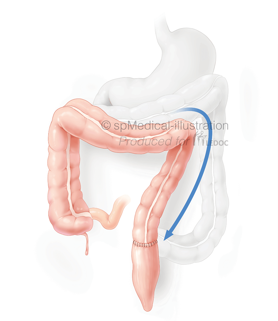 Rectum met naad