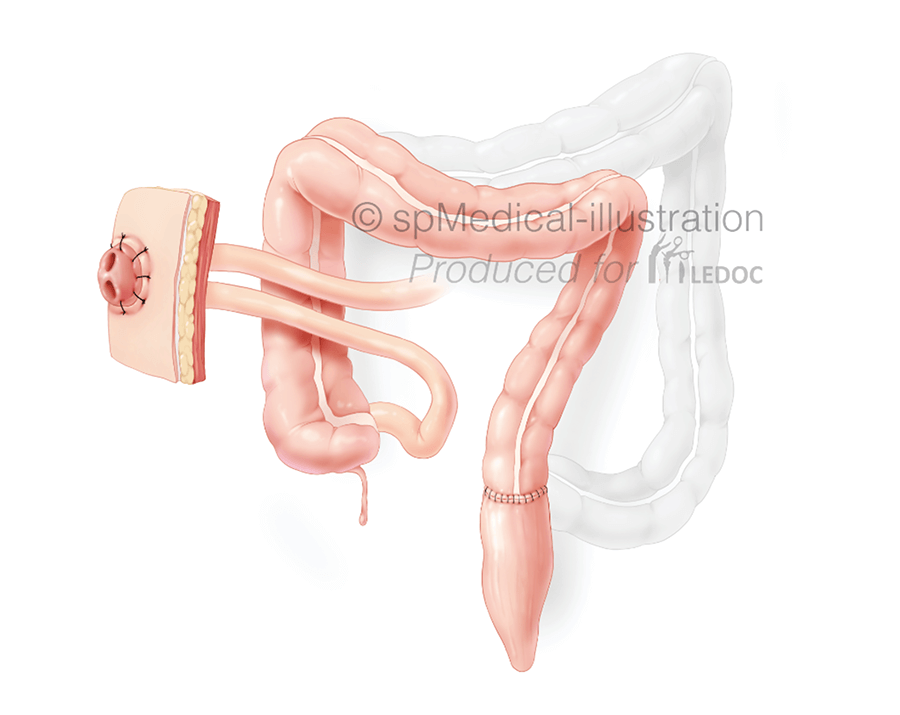 Protectief stoma