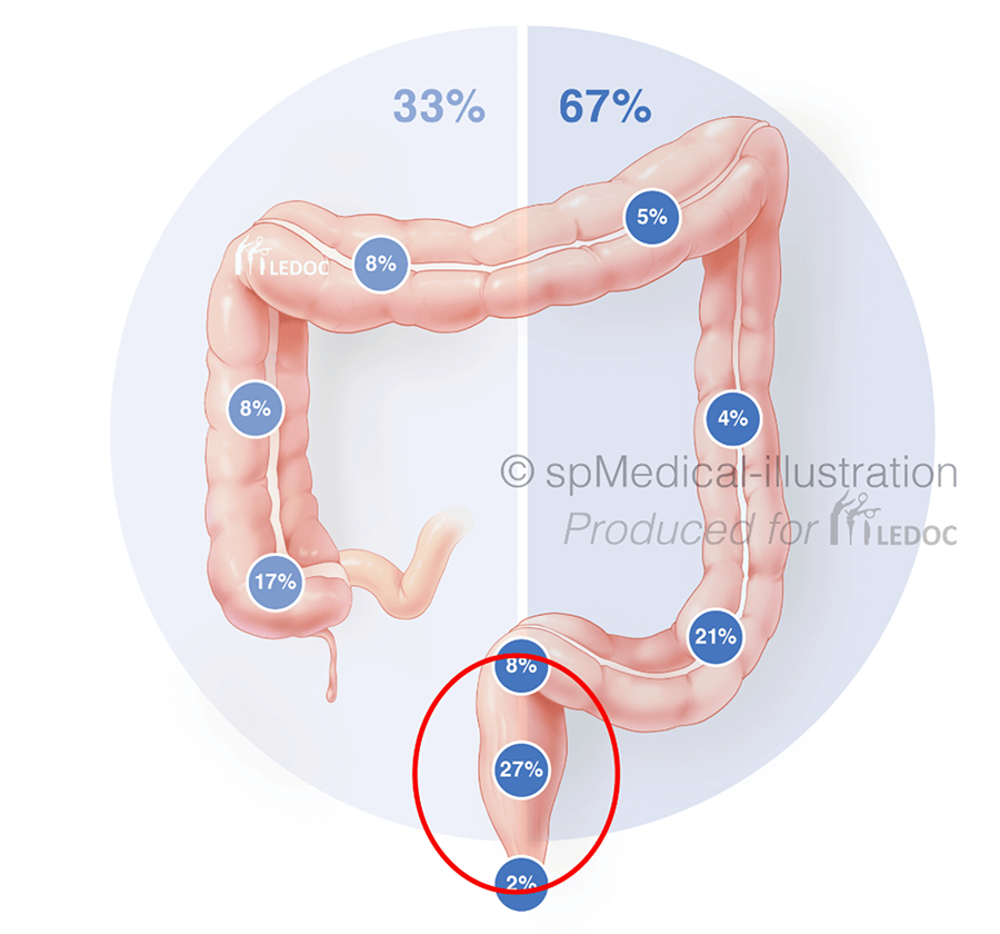 rectum tumoren Distributie