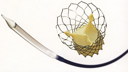 Core Valve