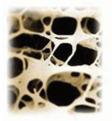 Osteoporose