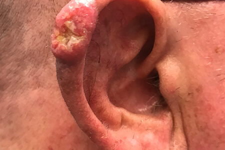 Spinocellulair carcinomen