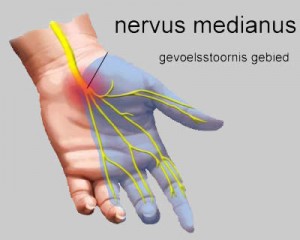 Gevoelsstoornissen bij carpal tunnel