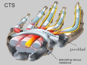 Knelling van de nervus medianus in de carpale tunnel