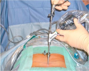 Peroperatieve foto met interlaminair ingebrachte endoscoop
