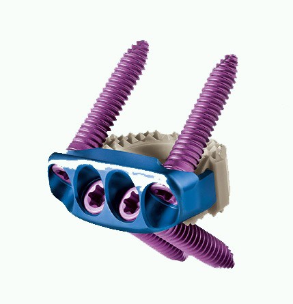 Cervicale cage PEEK + schroefjes