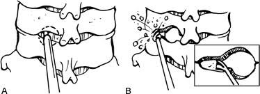 Cervicale Laminoforaminotomie