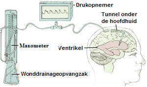 Schematische tekening van een intracraniële drukmeting