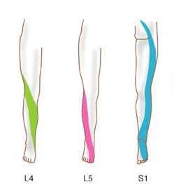 Frequente uitstralingspatronen volgens dermatoom