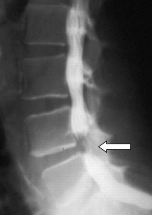Lumbale myelografie: hernia L4-L5