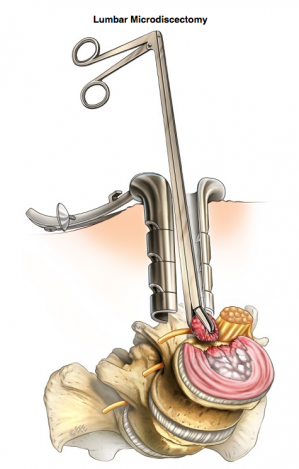 Microdiscectomie