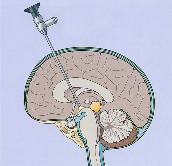 Endoscopische derde ventriculostomie