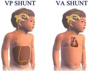 Soorten shunts