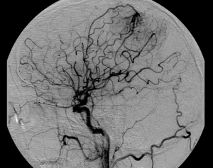 Angiografie meningeoom