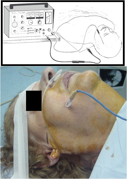 Thermocoagulatie (Kirschner procedure)