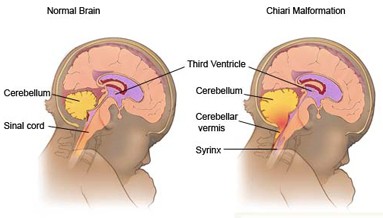 Chiari II malformatie