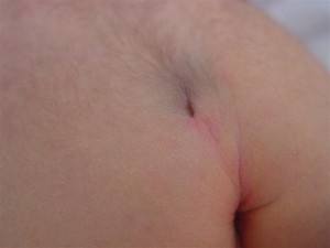 Spina bifida occulta "dimple"