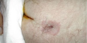 Spina bifida occulta huidverkleuring + haar