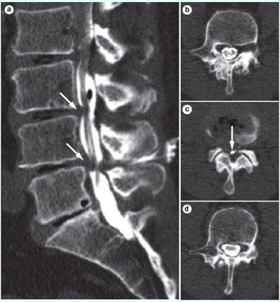 CT myelografie