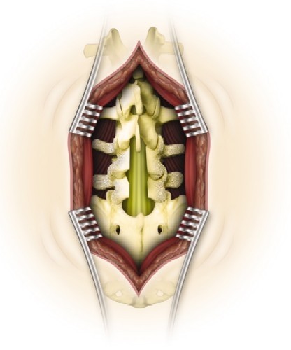Lumbale laminectomie