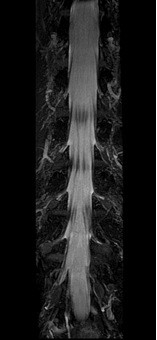 MRI myelografie