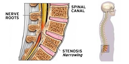 Spinale stenose
