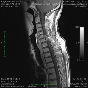 MRI van cervicale tumor C6-C7