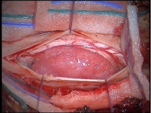 Voorbeeld van een intraduraal schwannoma t.h.v. de nek