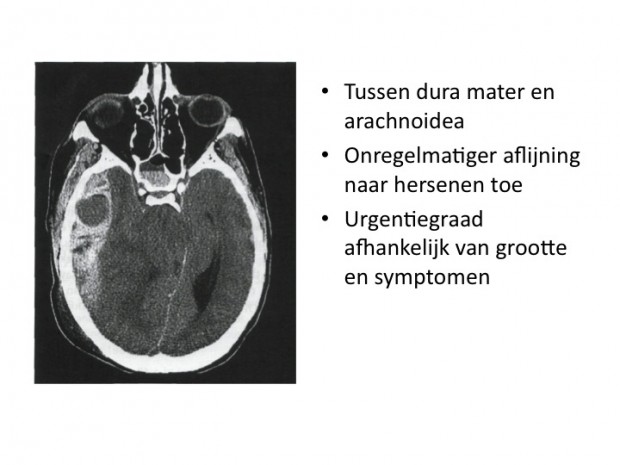 Acuut subduraal hematoom