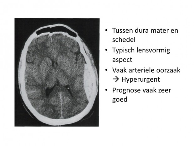 Epiduraal hematoom