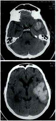 Intracerebrale bloeding