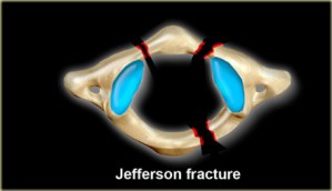 Jefferson fractuur
