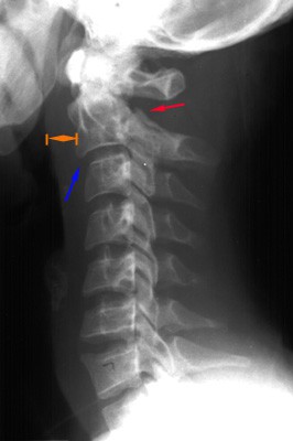 RX  van een Hangmanfractuur