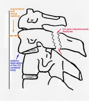 Schematische voorstelling van een Hangmanfractuur
