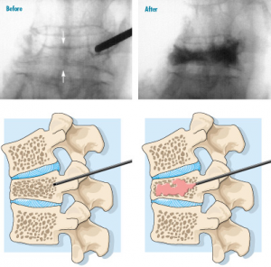 Vertebroplastie